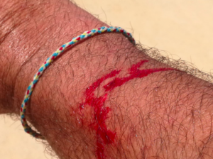 El braç de l'agredit