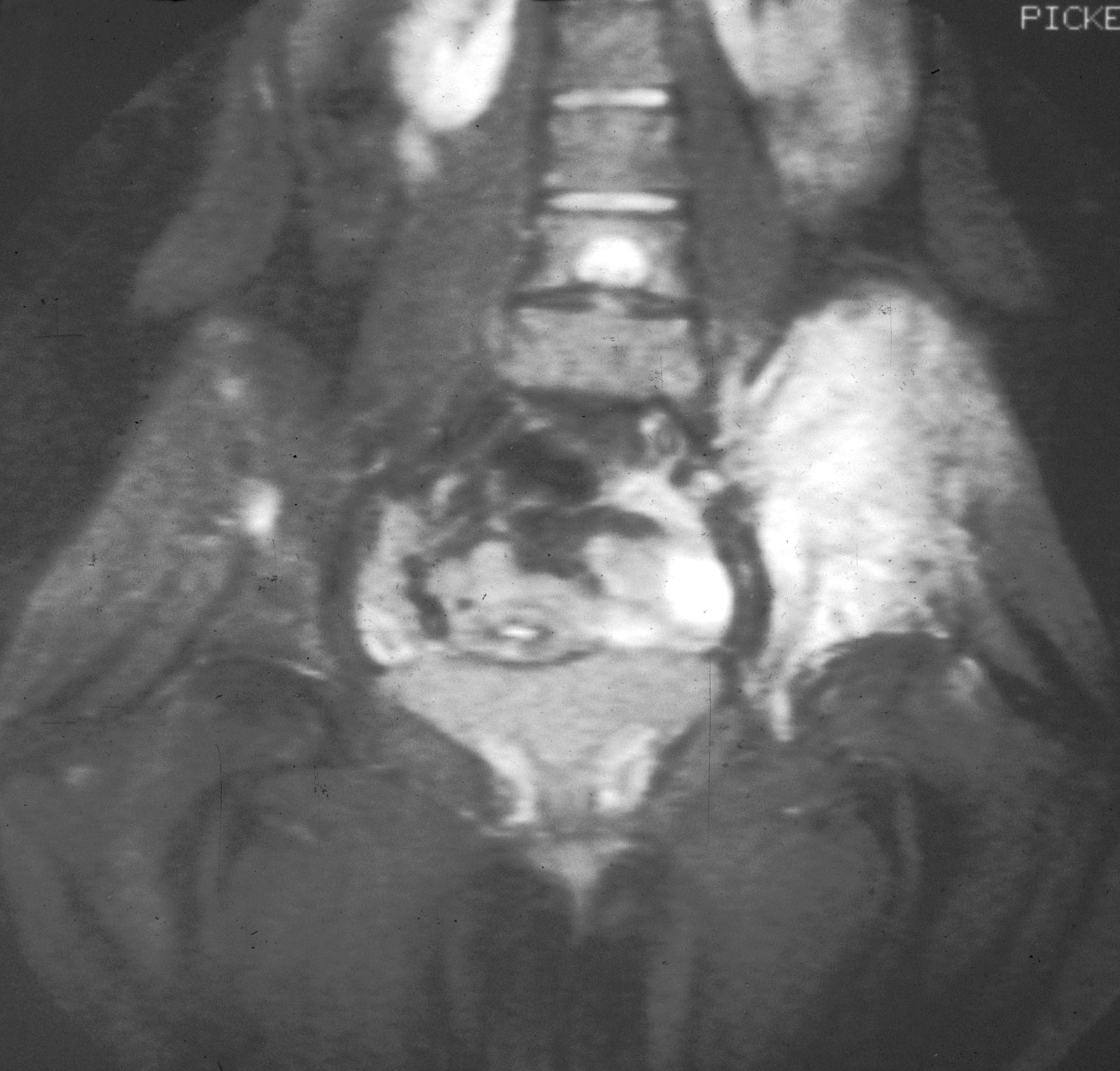Imatge d'una ressonància magnètica en què es pot veure el sarcoma d'Ewing en el maluc esquerra (l'àrea blanca ressaltada a la dreta) | Wikipèdia
