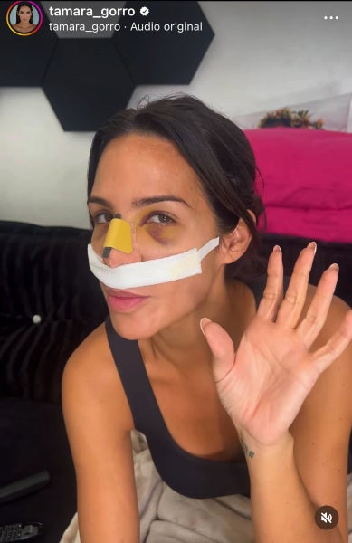 Tamara Gorro s'opera el nas i mostra imatge impactant- Instagram
