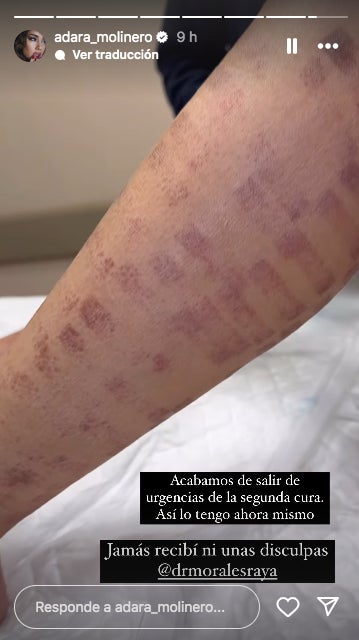 Així té Adara les cames actualment - Instagram