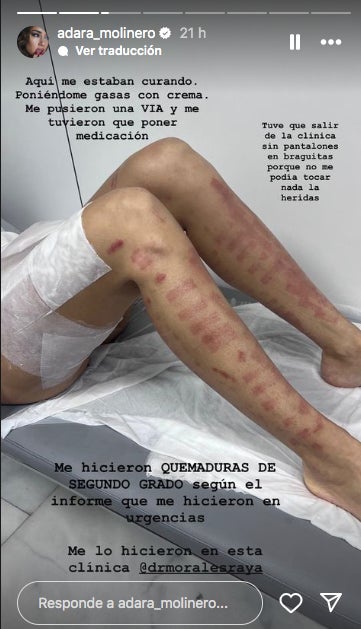 Així tenia les cames Adara després del tractament - Instagram