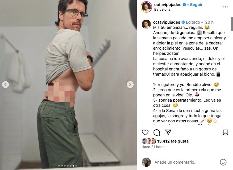 Octavi Pujades té́ un herpes muy grande en el cuerpo - Instagram