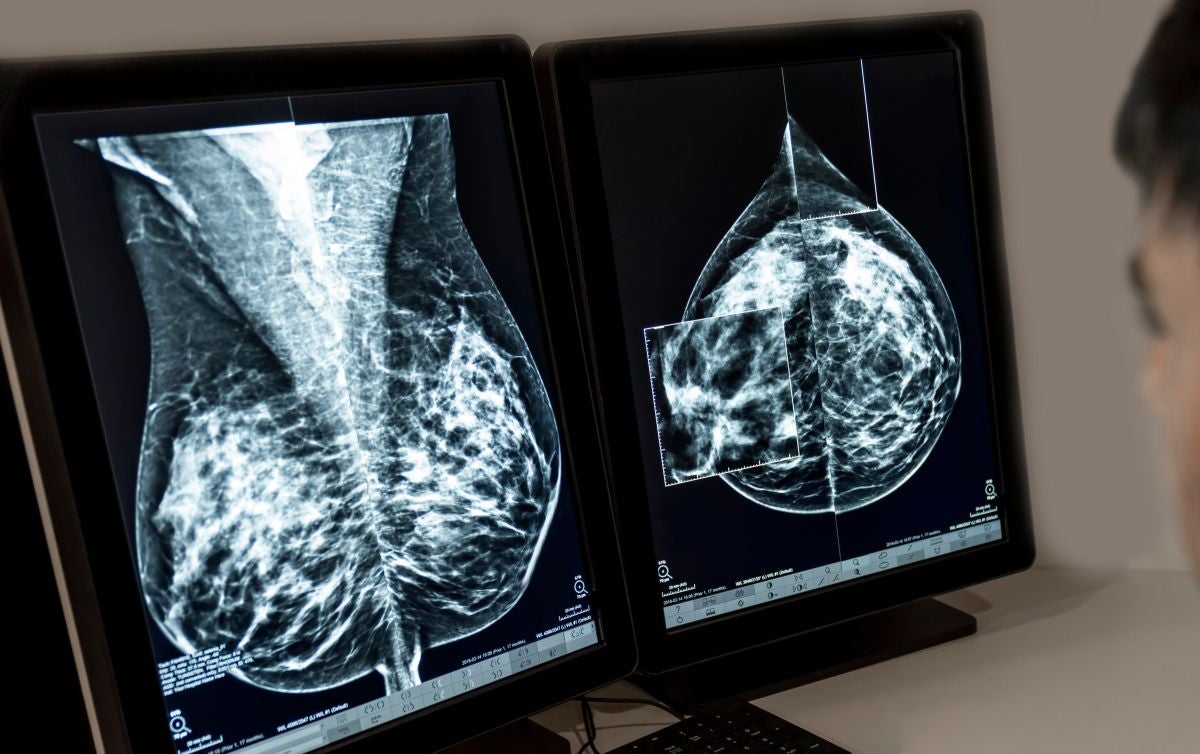 Una radiografia d'una pacient amb càncer de mama 