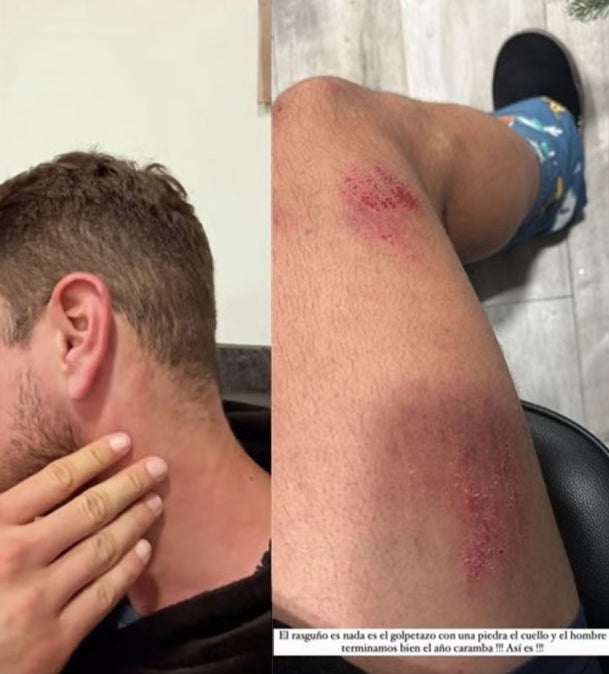 Alejandro Nieto publica fotos de les seqüeles de l'accident - Instagram