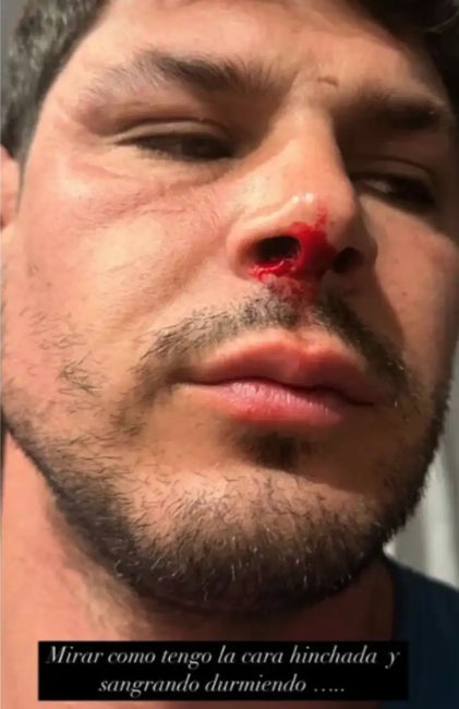 El guanyador de Supervivientes ha patit per culpa de la bici - Instagram