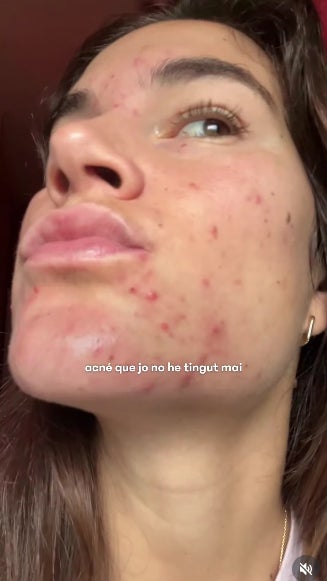 Així era el brot d'acnè tan fort que va tenir fa uns mesos - Instagram