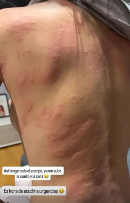 Fani de 'La isla' comparteix una foto impactant de la reacció al·lèrgica - Instagram