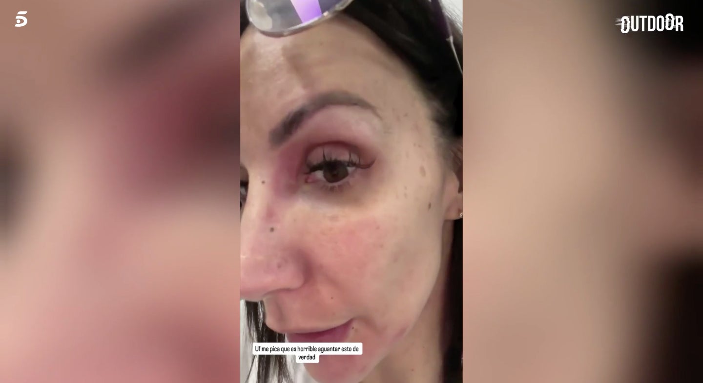 També a l'ull ha patit les conseqüències de la reacció - Instagram