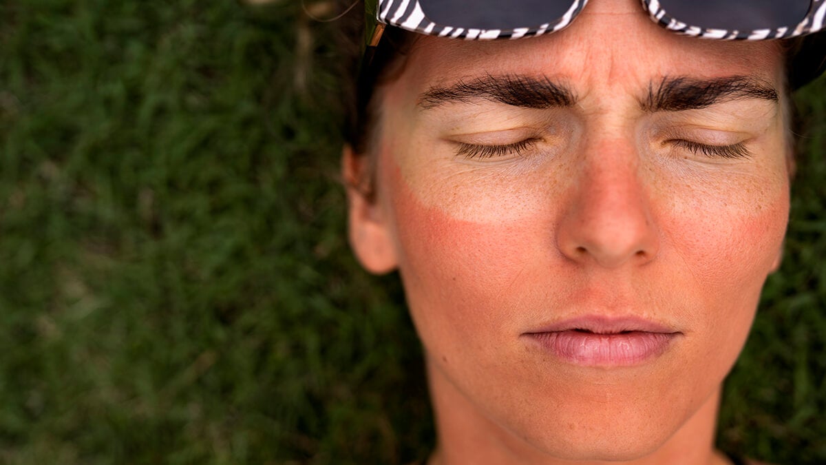 «No existece el callo estival» la advertencia de una dermatóloga sobre el daño acumulado del sol
